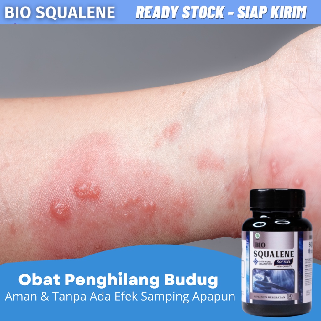 Obat Budug Di Kaki, Obat Budug Bernanah, Obat Budug Santri, Obat Gatal Budug, Obat Tangan Dan Kaki B