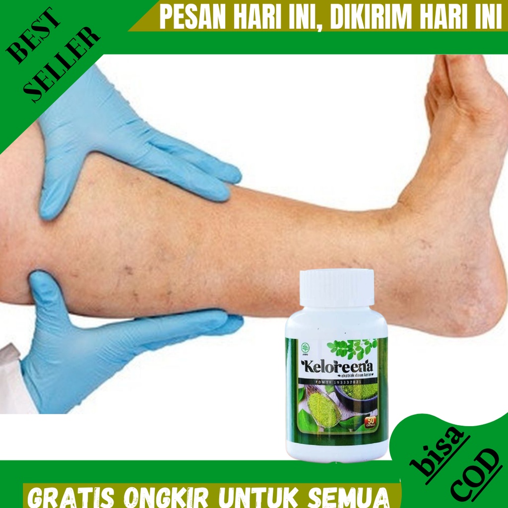 Obat Kaki Bengkak dan Nyeri, Obat Kaki Bengkak Asam Urat, Obat Kaki Bengkak Memar, Obat Kaki Bengkak
