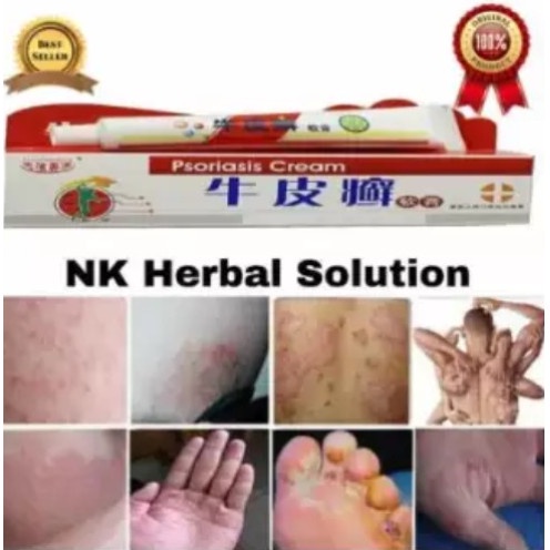 PSORIASIS Cream Cina Ampuh Mengatasi Exim dan Macam Penyakit Kulit