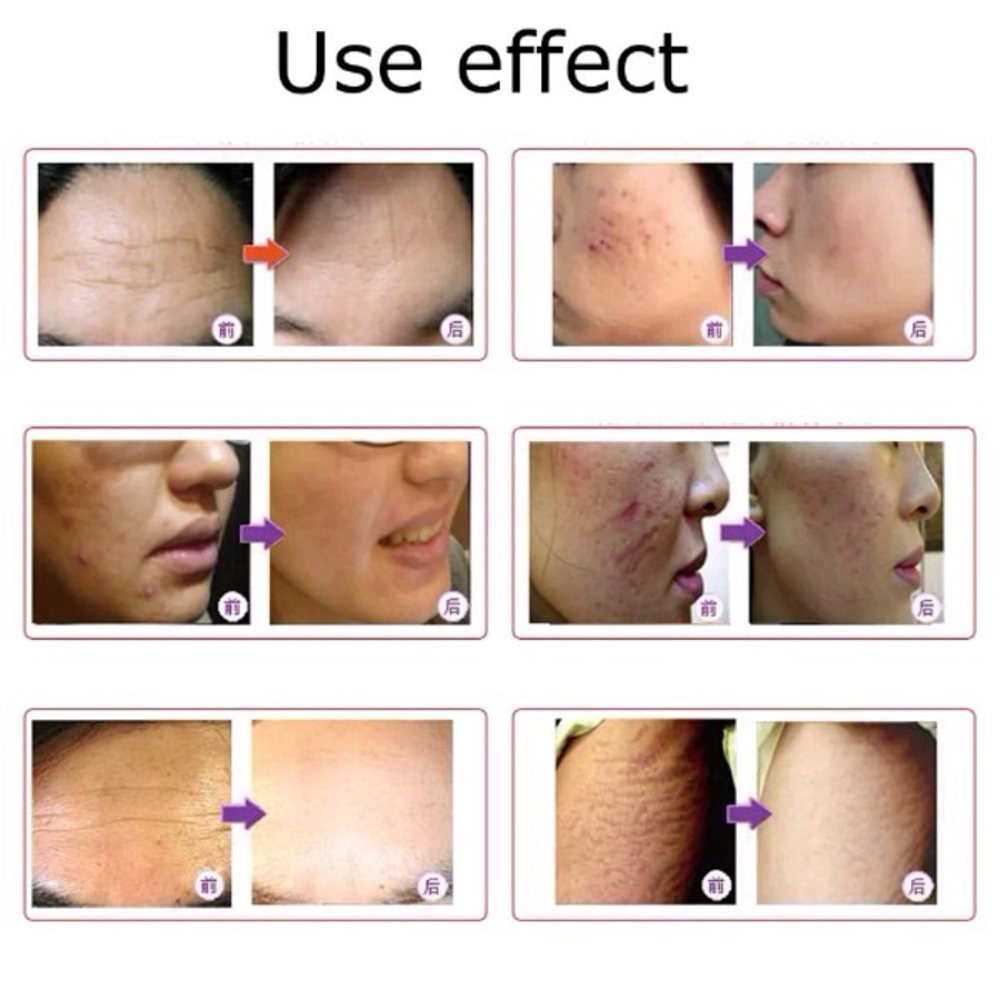 Promo Dr.pen M7 Wireless Derma pen Dermapen Dr. pen dr pen A1 MYM M5 BB glow Diskon