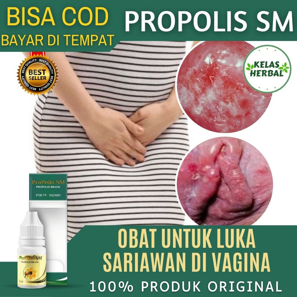 Obat Sariawan Pada Vagina, Luka Lecet di Bibir Vagina, Luka Dalam Vagina, Nyeri, Perih, Panas Saat K