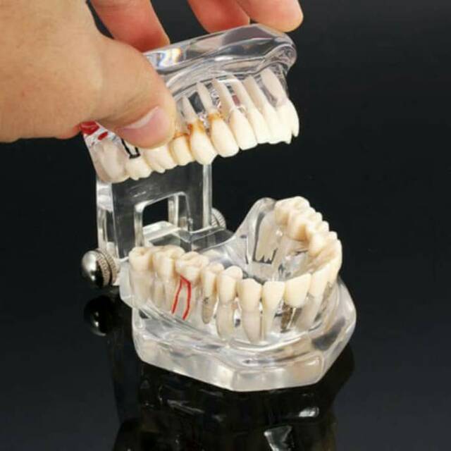 Dental study model caries impacted teeth crown bridge implan patung gigi