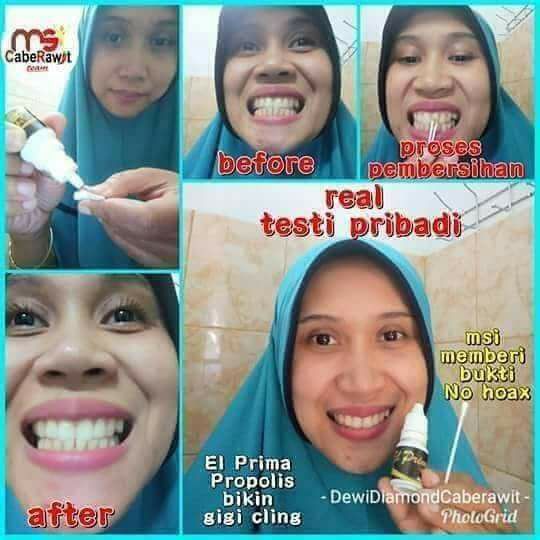 Obat Perontok Karang Gigi Propolis Elprima Ganti Kemasan Jadi Plavid Harga Perbotol Shopee Indonesia