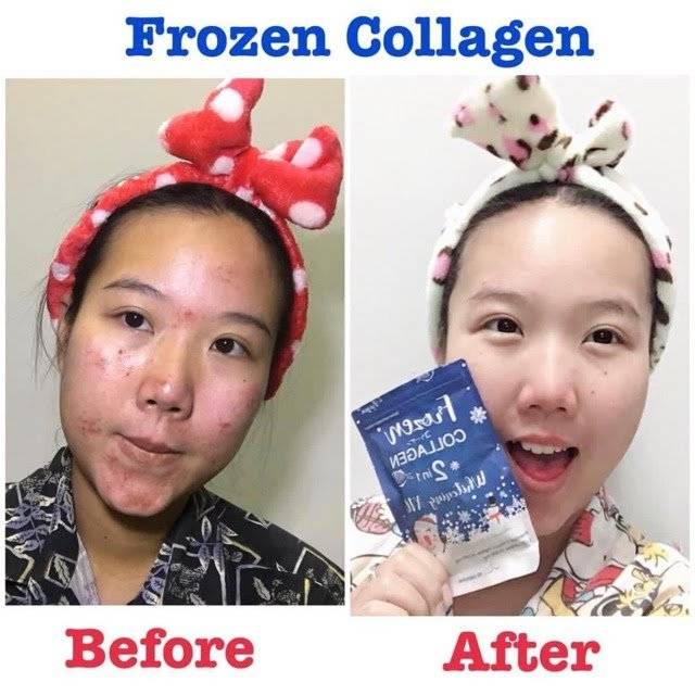 Frozen collagen 2in1 whitening