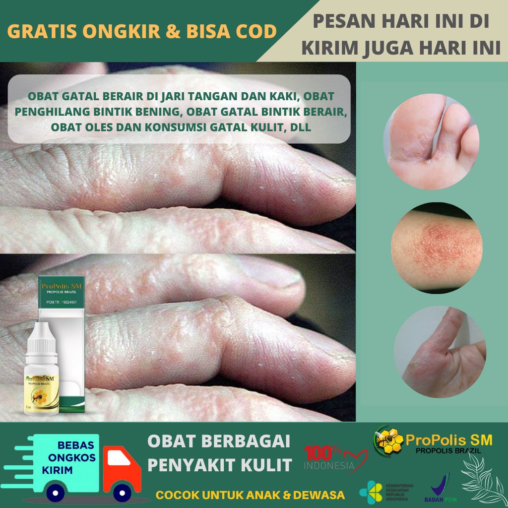 Jual Obat Gatal Berair Di Jari Tangan Dan Kaki Obat Gatal Penghilang Bintik Bintik Berair Obat 5182