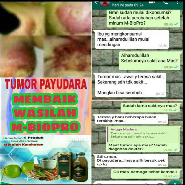 

TUMOR GANAS TERATASI