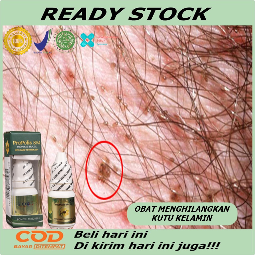 Obat Tetes Pembasmi Kutu Rambut Kemaluan Alami - Penghilang Kutu Pubis Kelamin - Obat tetes kutu kem
