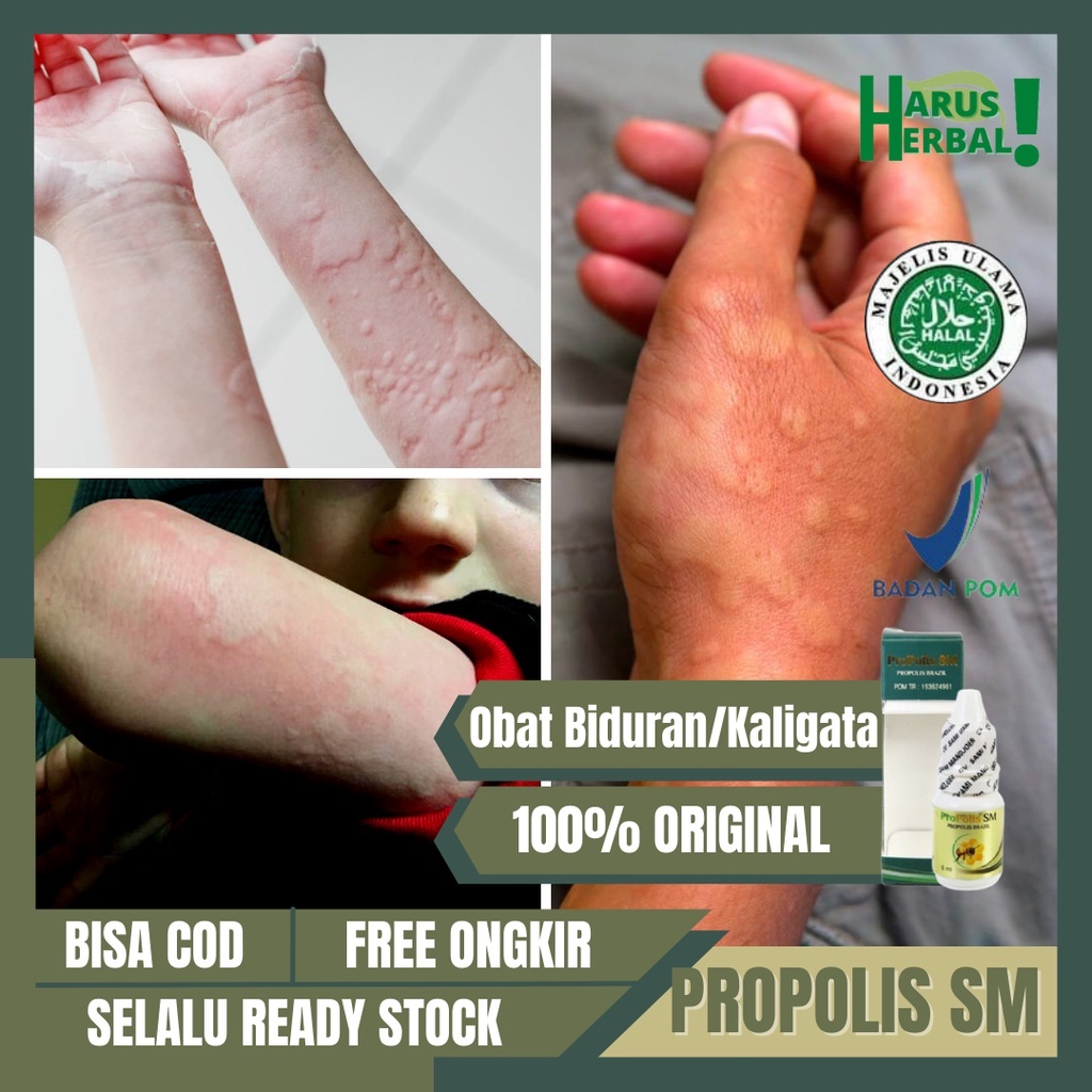 Obat Mengatasi Kaligata/Biduran Dengan PROPOLIS SM, Obat Gatal Kaligata/Biduran, Obat Oles Kaligata,