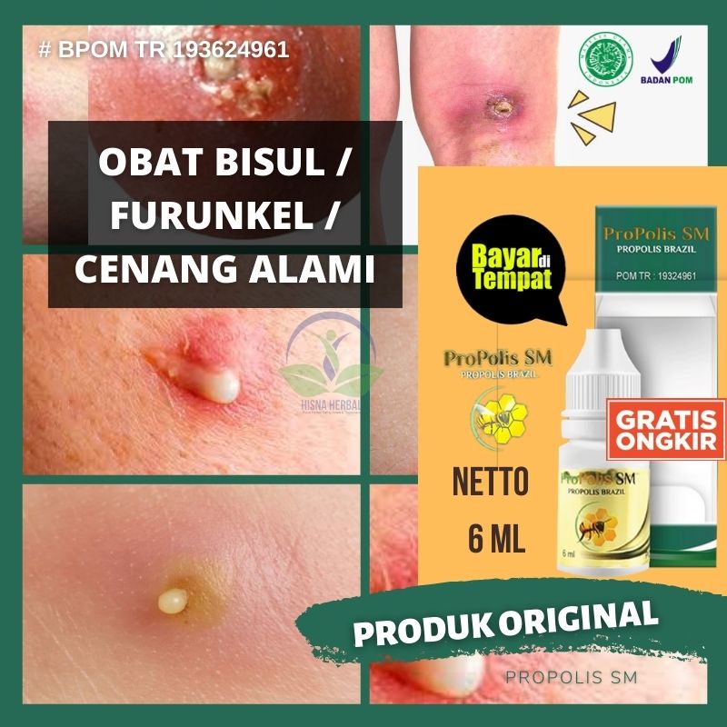 Obat Untuk Bisul, Bisulan, Benjolan Cenang Bernanah, Darah Kotor, Obat Luka Korengan, Nanahan, Cenang, Tubuh Gatel2 Parah, Koreng, Jerawat, Borok, Eksim, Herpes, Alergi, Obat Bisul Di Tangan Dan Kaki Dengan Propolis SM Bukan Krim Atau Salep Cina