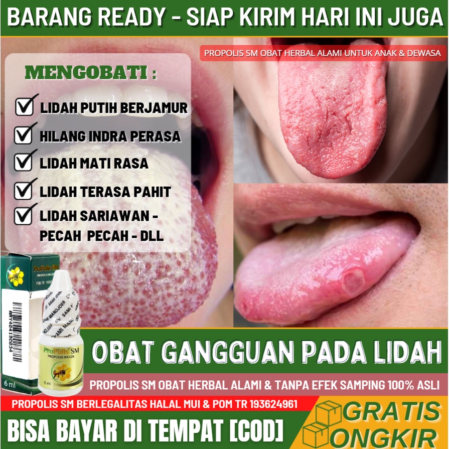 Obat Herbal Kandidiasis / Infeksi Jamur Pada Lidah & Mulut 100% ALAMI, Obat Lidah Terasa Pahit, Lida