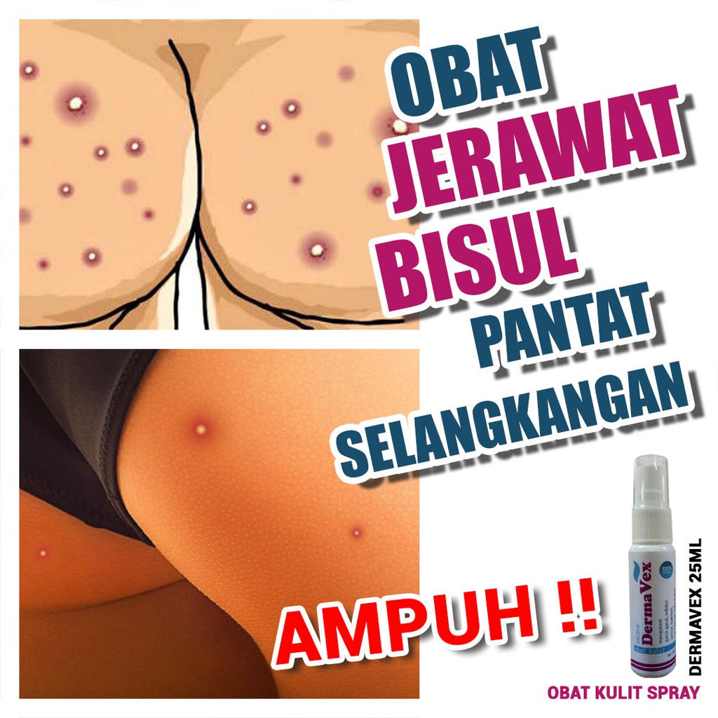 Obat Jerawat Bisul Pantat Selangkangan Dermavex 25ml Shopee Indonesia