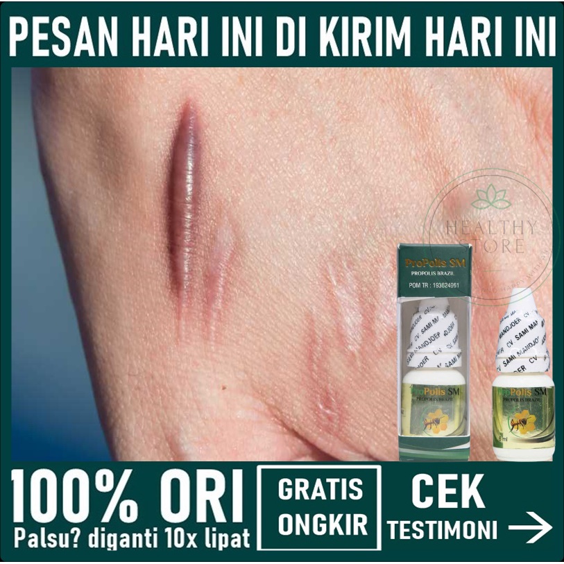 Penghilang Bekas Luka - Penghilang Keloid yang sudah lama - Obat Keloid Bekas Luka Operasi