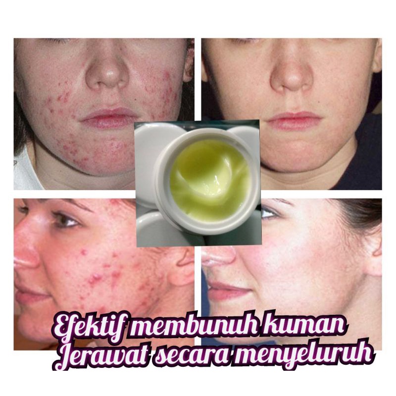 Penghilang Jerawat Batu Pria wanita Ampuh Original Permanen obat Penghilang bekas Jerawat