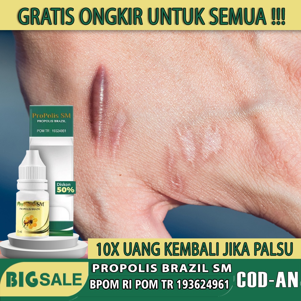 Obat Herbal Keloid Bekas Luka, Keloid Bekas Sesar atau Caesar, Keloid Bekas Jerawat, Keloid Bekas Op
