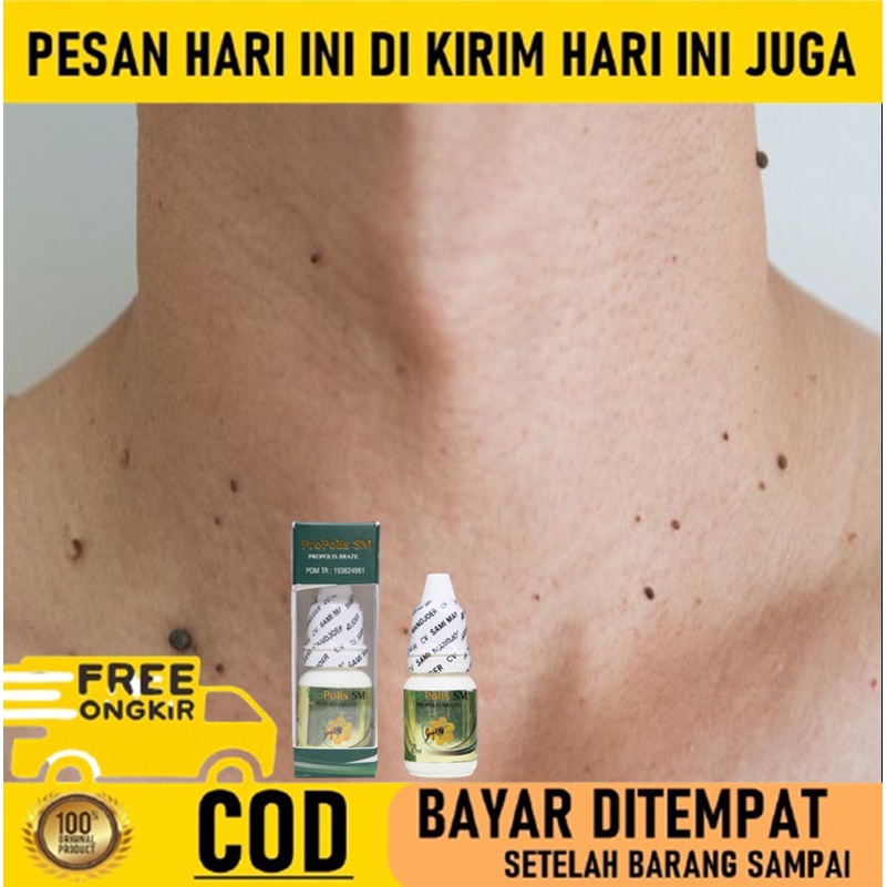 Obat Kutil di leher - Obat Penghilang kutil - Obat Papiloma - Obat Papiloma leher - Penghilang kutil