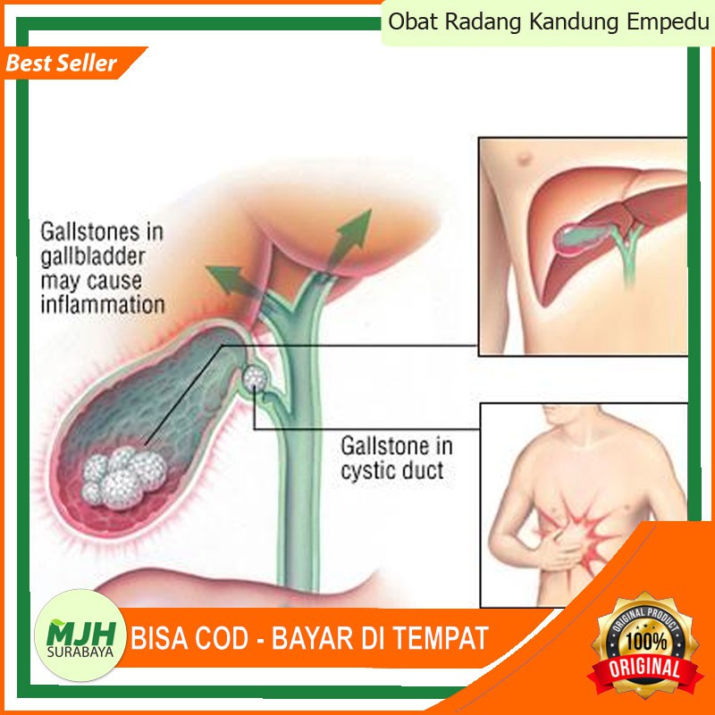 Obat Radang Kandung Empedu | Kandung Empedu Bengkak | Benjolan Kandung Empedu | Sakit Kandung Empedu