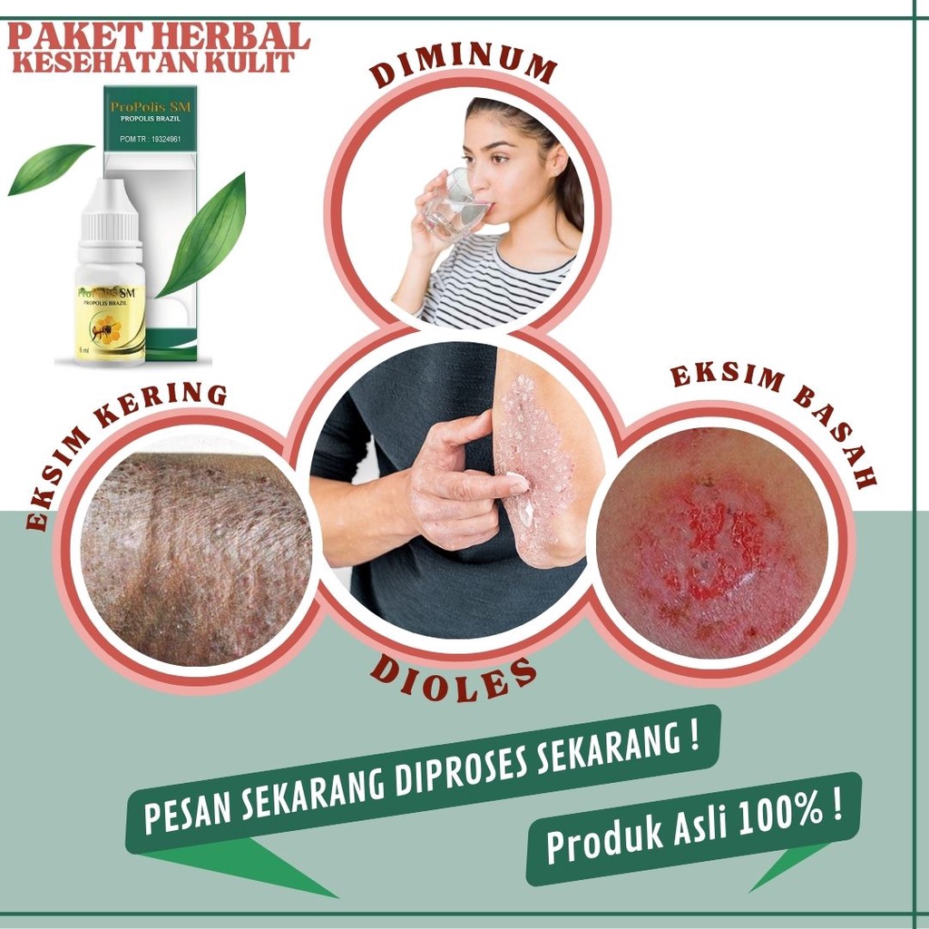 Obat Eksim Kering Menahun, Obat Eksim Basah, Salep untuk Eksim, Obat Gatal Eksim, Obat Eksim Kering 