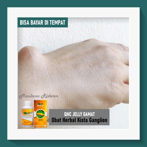 Obat Kista Ganglion, Benjolan Di Pergelangan Tangan, Obat Penghancur Kista Ganglion QnC Jelly Gamat