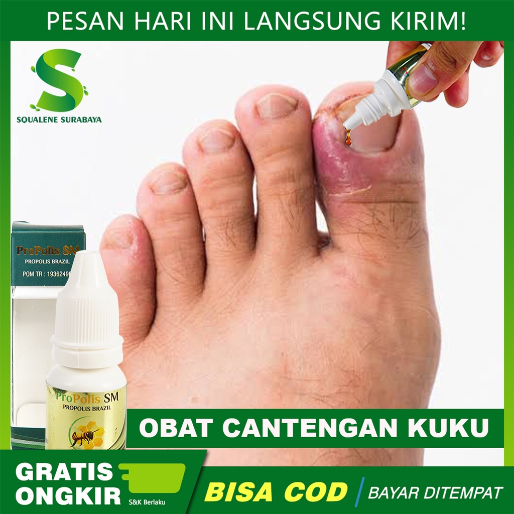 Obat Cantengan Kuku, Jempol kaki Bernanah, Cantengan Parah, Cantengan Kaki/Tangan Dengan Propolis Sm