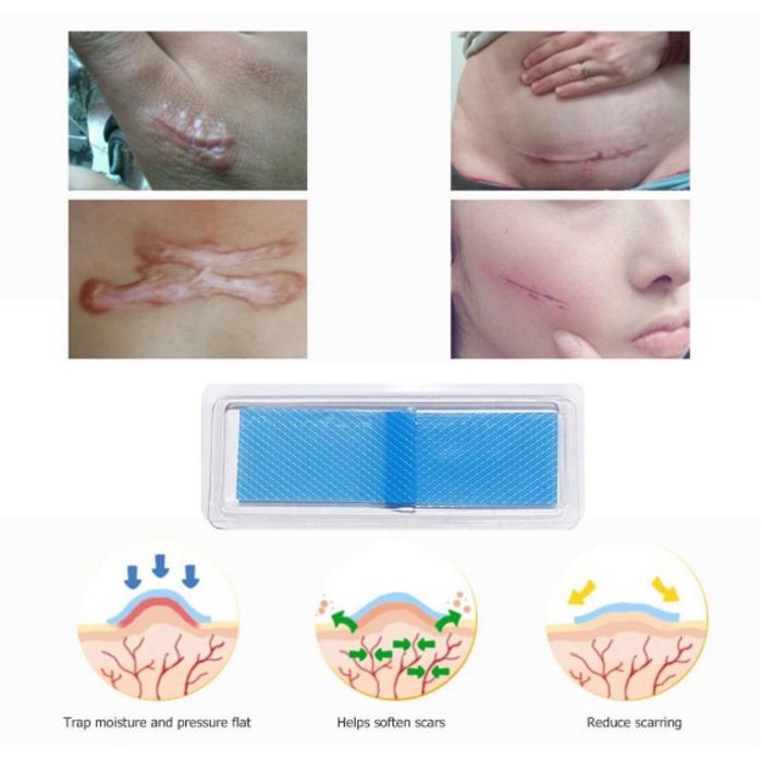 OBAT PENGHILANG LUKA SCAR REMOVAL SILICONE PATCH TRETCH MARK