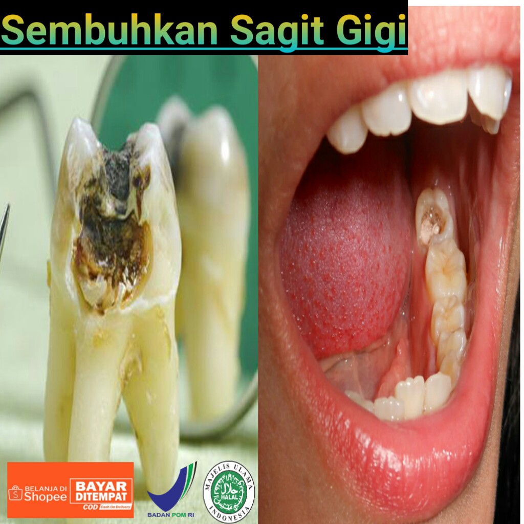 Special Obat Sakit Gigi Berlubang Dan Gusi Bengkak Herbal Naturindo Shopee Indonesia