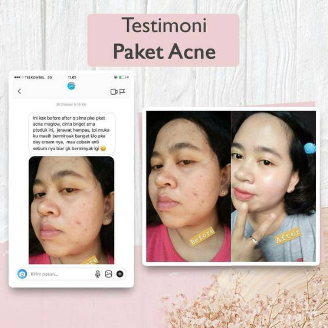 Ms Glow #Free Gift Acne Series Original Barcode Msglow Original - Paket Acne Basic (Paket Jerawat)-1