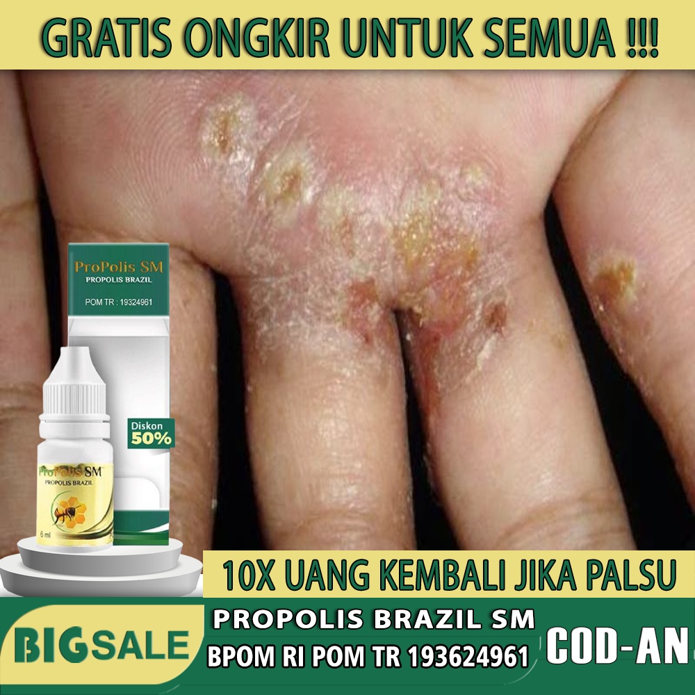 Obat budug bernanah, obat kulit bernanah, obat scabies menahun, obat scabies herbal, Obat koreng di 