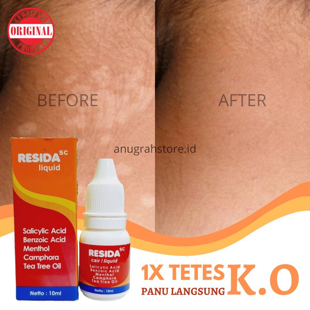 Resida Cair 10 ml Obat Panu Original Obat Panu Paling Ampuh 100% Cair Original Bpom Penghilang Gatal