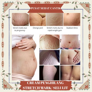 Vibrant Penghilang Strechmark Salep Penghilang Bekas Luka Penghilang Keloid Penghilang Selulit Ampuh