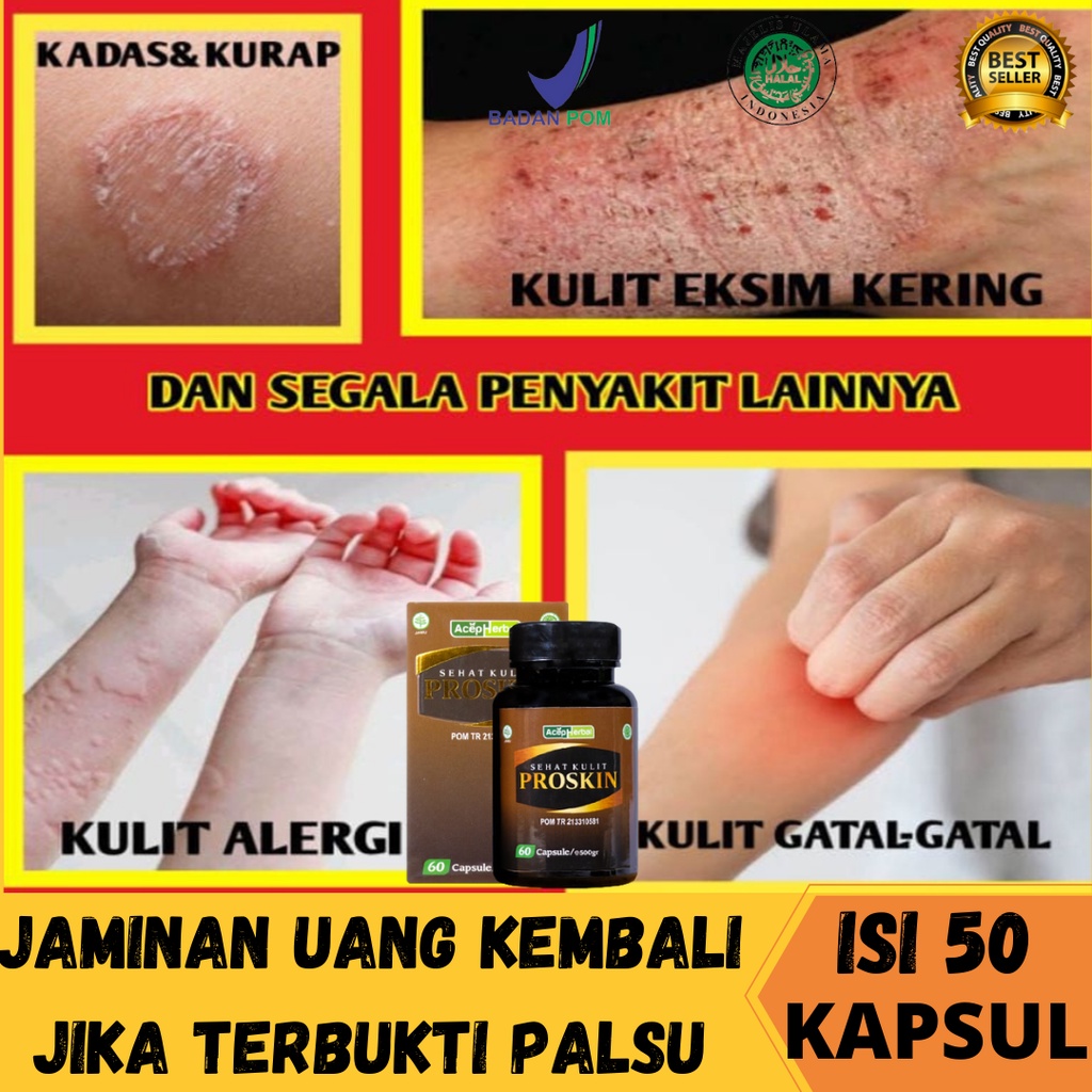 Obat Gatal / Obat Kurap, Obat Gatal Kulit, Obat gatal alergi dan penyakit kulit, Obat gatal kulit ek