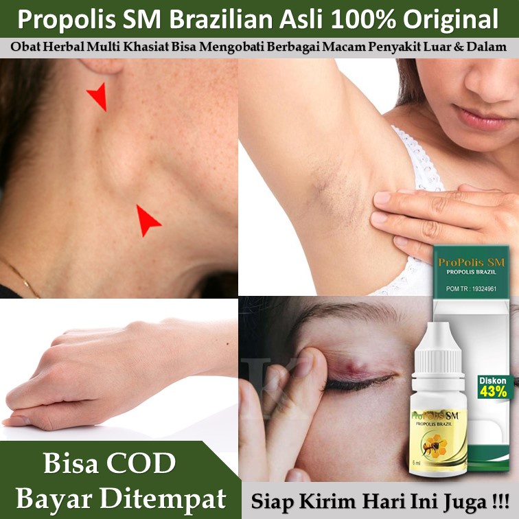 Herbal Obat Gondok Obat Kelenjar Tiroid Obat Benjolan Di Leher Obat Gondok Teroid | POPOLIS SM 100% 
