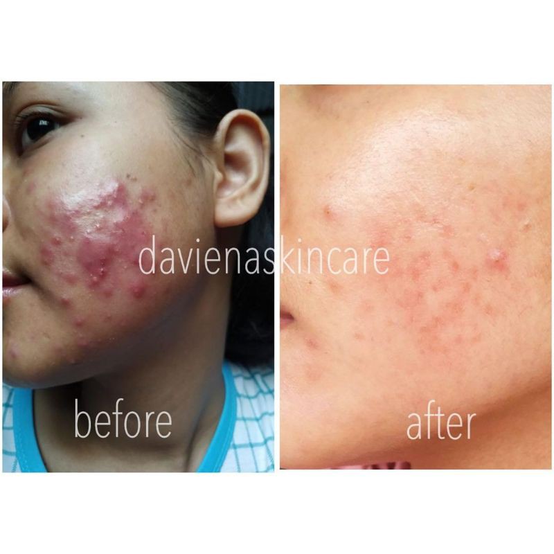 DAVIENA SKINCARE ACNE SERIES|DISTRIBUTOR DAVIENA|BEST SELLER|davienaskincareofficial|ramadhanidavin|davienaskincarejakarta|davienaskincaresurabaya|vidbeauty|davienaskincarejambi