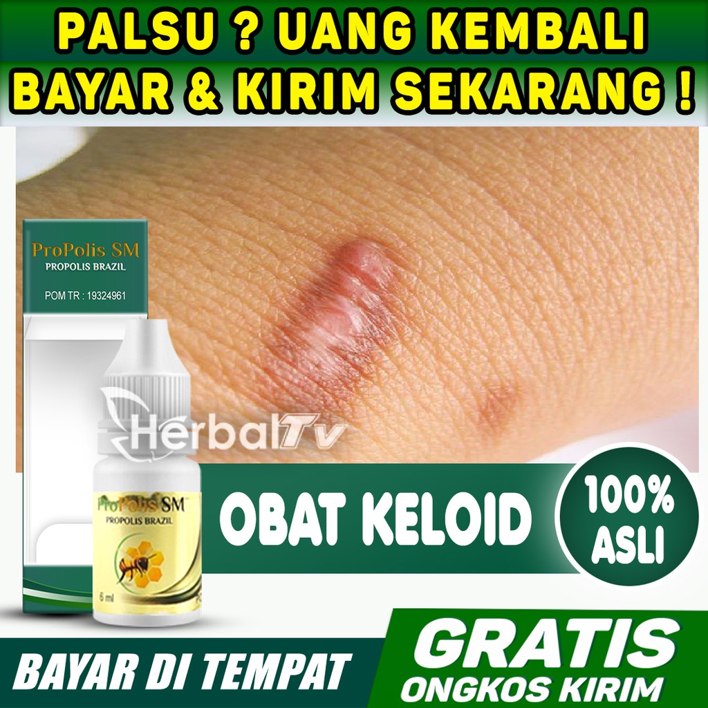 Obat Keloid Herbal, Benjolan Menahun, Penghilang Daging Tumbuh Bekas