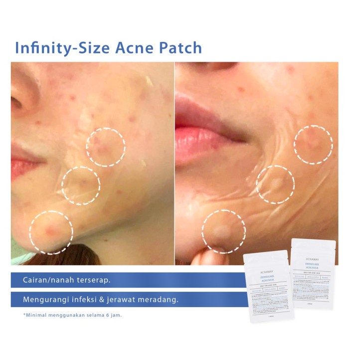 ACNAWAY Infinity Size Acne Patch / ACNAWAY Ultra Thin Acne Patch Day / ACNAWAY Patch / ACNAWAY Stubborn Acne Cream