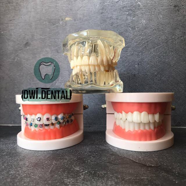 Dental model study gigi bening model studi gigi brace rahang gigi