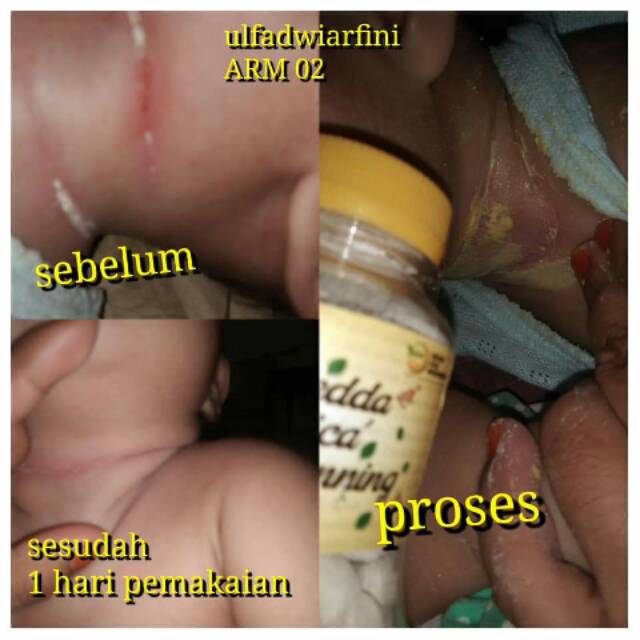 BEDDA PICA MACENNING