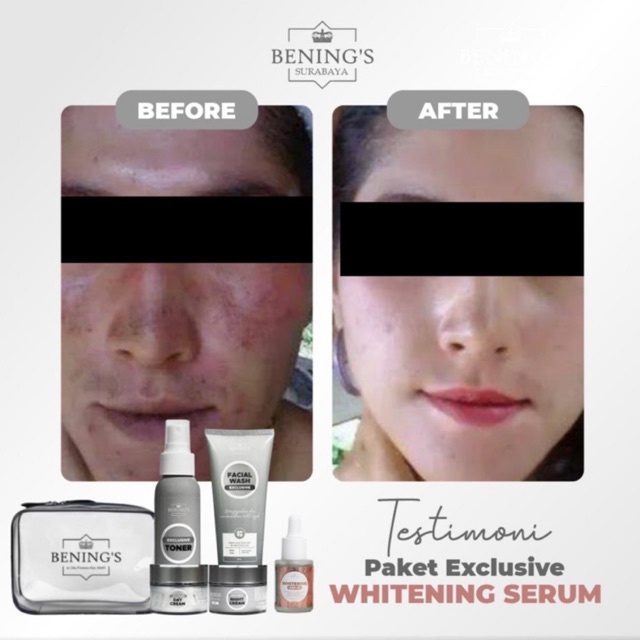 BENING'S PAKET EXCLUSIVE | MENGATASI FLEK, MELASMA &amp; MENCERAHKAN KULIT