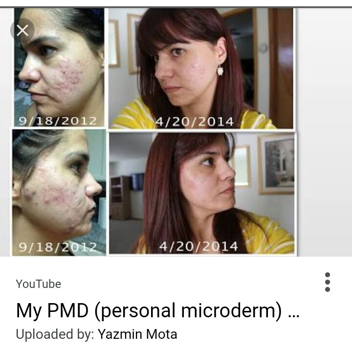 ORIGINAL PMD PRO Personal Microderm Alat Mikrodermabrasi Microdermabration Acne Scar Tool Kit