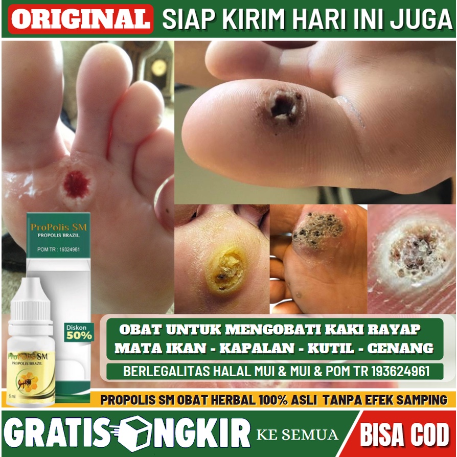 Jual Obat Mata Ikan Obat Perontok Kutil Obat Kaki Rayapan Obat