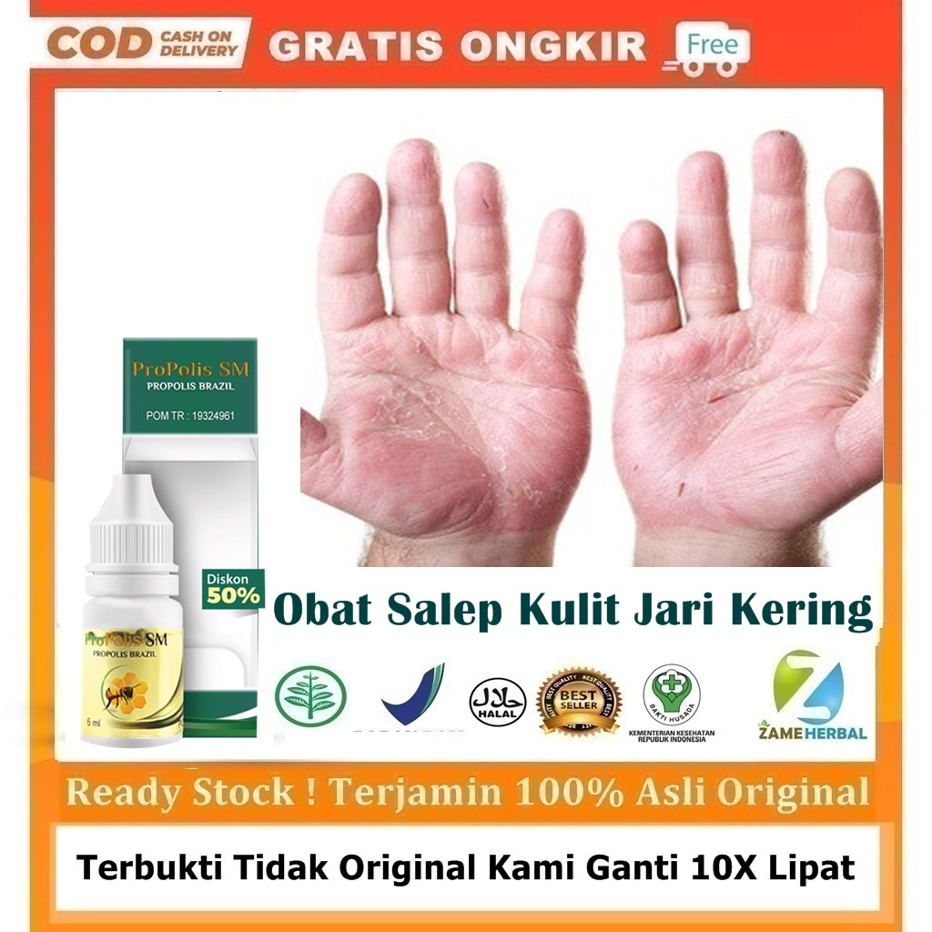 Obat Salep Kulit Jari Kering, Penghilang Kulit Tangan Pecah Pecah, Bersisik, Mengelupas, Gatal