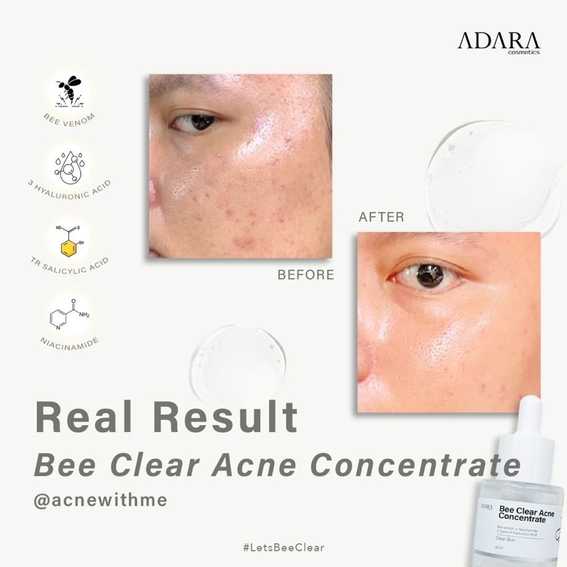 ADARA P.M.S Series Acne Spot Bee Clear Acne | Extra Formula | Serum Acne | Adara Moisturizer | Facewash Acne | Toner Acne | Acne Treatment jerawat