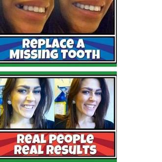 PROMO PENAMBAL GIGI OMPONG TEMPTOOTH ORIGINAL MURAH 300 BUTiR Lebih