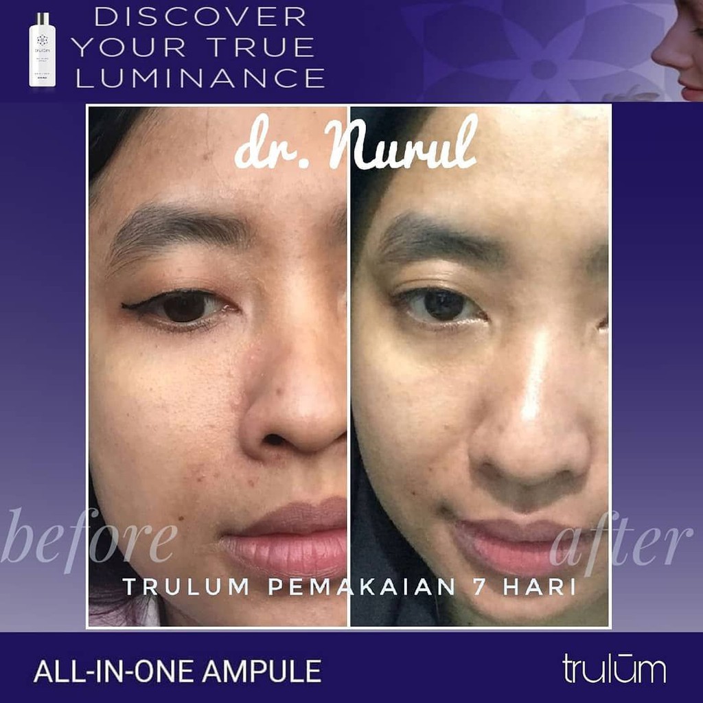 

Herbal Penghilang Jerawat Meradang Sakit Serum Import USA