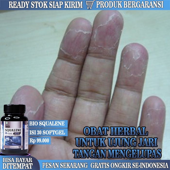 Obat Jari Tangan Kering, Obat Kulit Jari Tangan Kering Dan Mengelupas, Obat Kulit Jari Tangan Menger