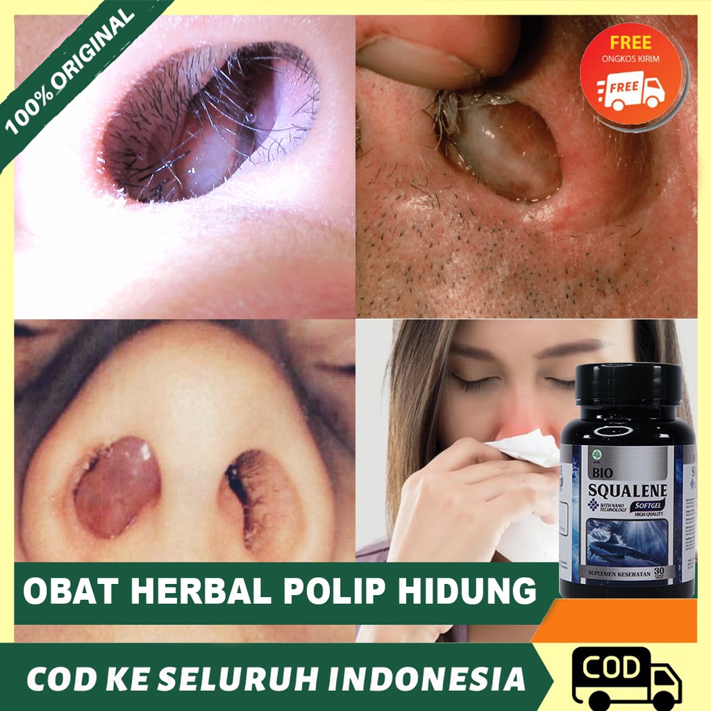 Obat Polip Hidung, Tumor Hidung, Flu Menahun, Sinusitis - Atasi Dengan Bio Squalene Softgl 100% Asli