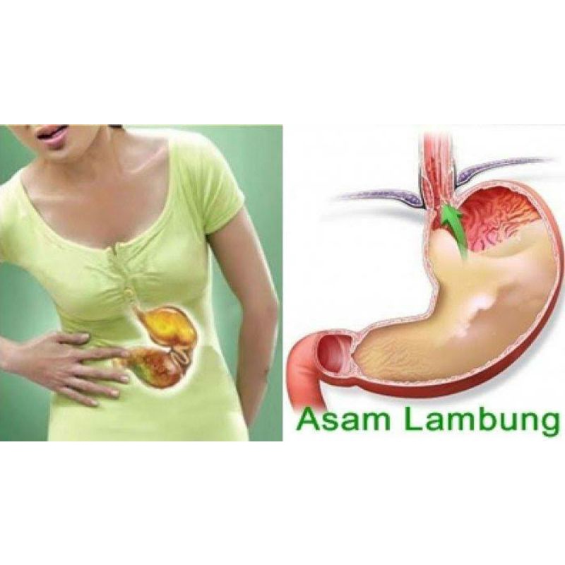 

Herbal Foshan Pengobatan Asam Lambung / Gerd Manjur
