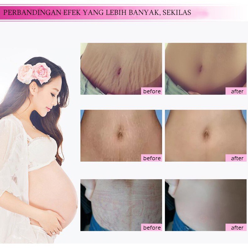 Stretch mark cream Krim stretch mark Secara efektif menghilangkan stretch mark Tujuh hari untuk menghilangkan stretch mark dengan cepat Pilihan banyak ibu