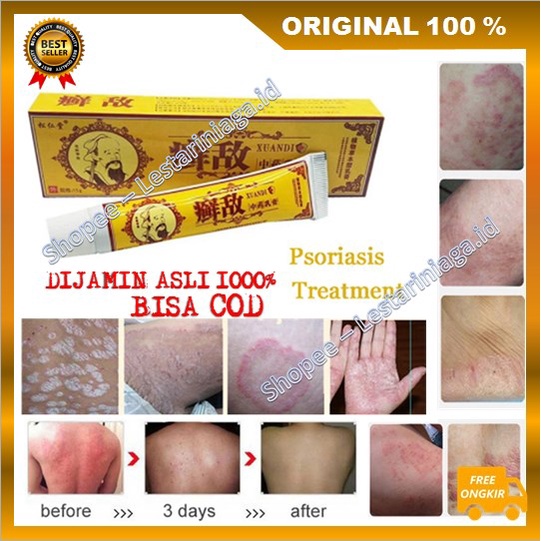 [BISA COD] Obat Herbal Cina Atasi Psoriasis Eksim Cream Psoriasis Ampuh 100% ASLI