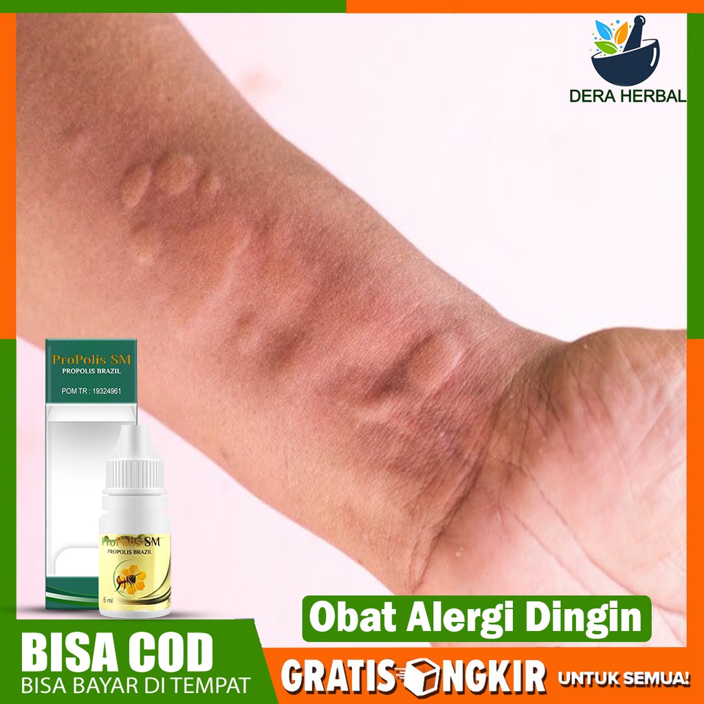 Obat Alergi Dingin Obat Alergi Gatal Gatal Obat Alergi Propolis Sm Herbal Original Gold Bisa COD