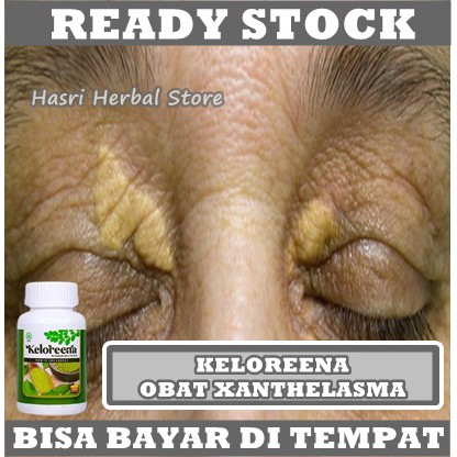 Obat Penghilang Xanthelasma - Obat Mata Xanthelasma, Obat Penghilang Lemak Kuning Di Ujung Mata, Obat Xanthelasma Di Apotik, Obat Gumpalan Lemak di Kelopak Mata, Obat Rekomendasi Penyakit Xanthelasma, Salep Kuning Di Sudut Mata Dengan Keloreena